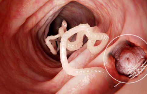 červ je parazit v lidském těle