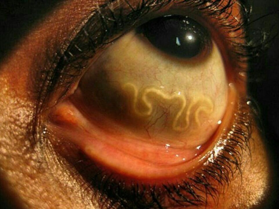 parazity v lidském oku